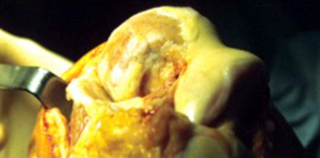 Implantation eines künstlichen Kniegelenks