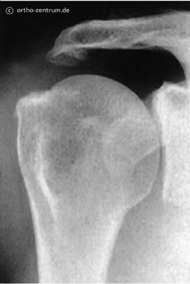 Subacromialraumes durch einen Knochensporn